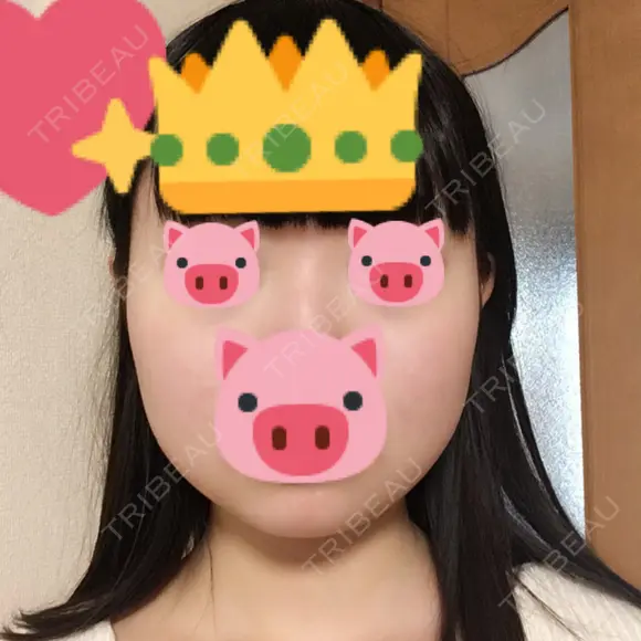ボトックス（エラ・小顔） / 脂肪溶解注射（顔） 湘南美容クリニック 松戸院 BEFORE メイン用