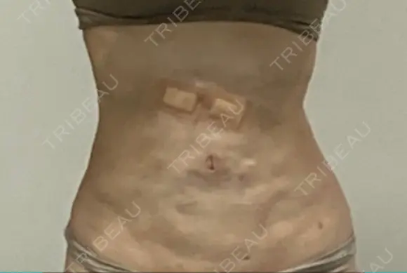 脂肪吸引（二の腕） / 脂肪冷却（お腹） Mods Clinic（モッズクリニック） 東京院 BEFORE メイン用