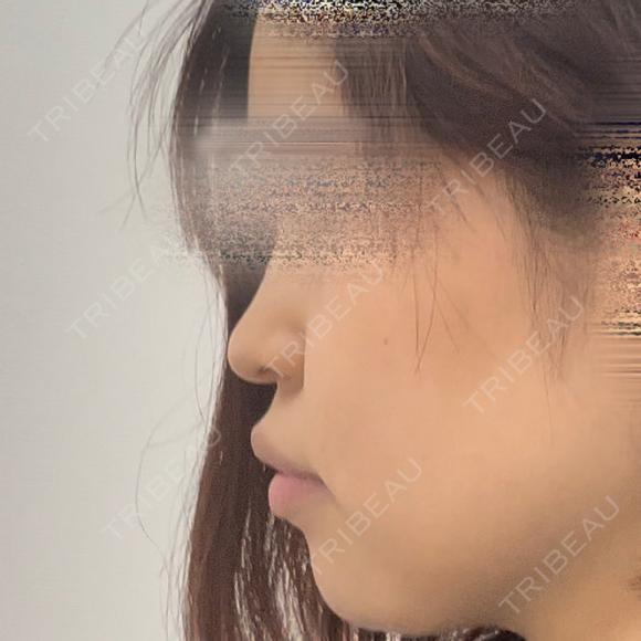 鼻尖形成（切開） / 糸リフト / 脂肪吸引（顔） / ジョールファット除去 / ヒアルロン酸注入（あご） / ヒアルロン酸注入（唇） / ボトックス（口角） / ヒアルロン酸注入（額） / ヒアルロン酸注入（鼻翼基部） 東京シンデレラ美容外科 池袋院 BEFORE メイン用