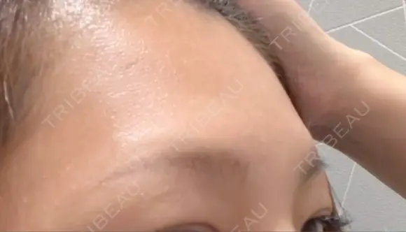 ヒアルロン酸注入（額） LA CLEF CLINIC（ラクレクリニック） BEFORE メイン用