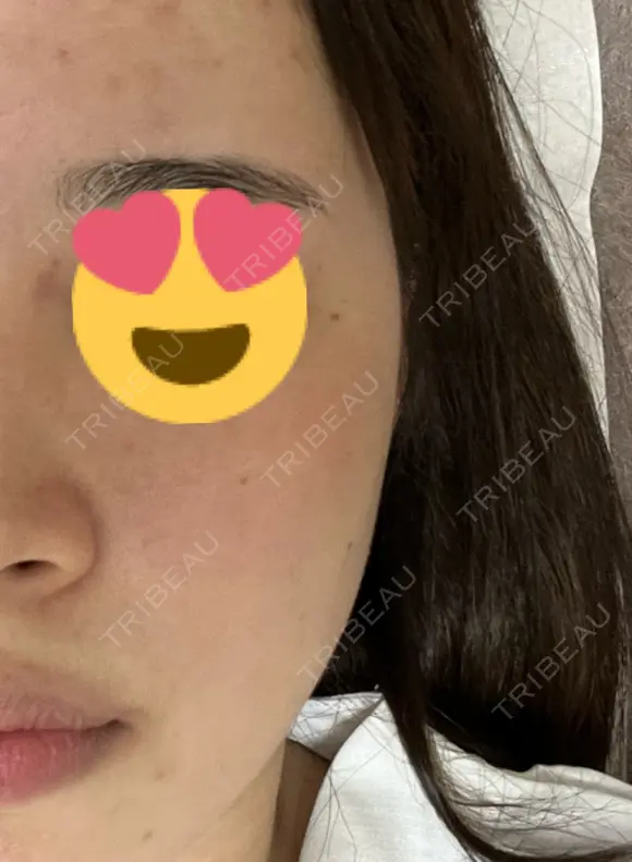 ピーリング（ニキビ・毛穴） LIFIX BEAUTY CLINIC BEFORE メイン用