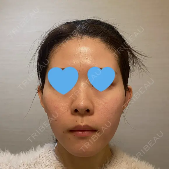 隆鼻術 / 鼻中隔延長（切開） / 鼻翼基部形成（貴族手術） ヴェリテクリニック 銀座院 BEFORE メイン用