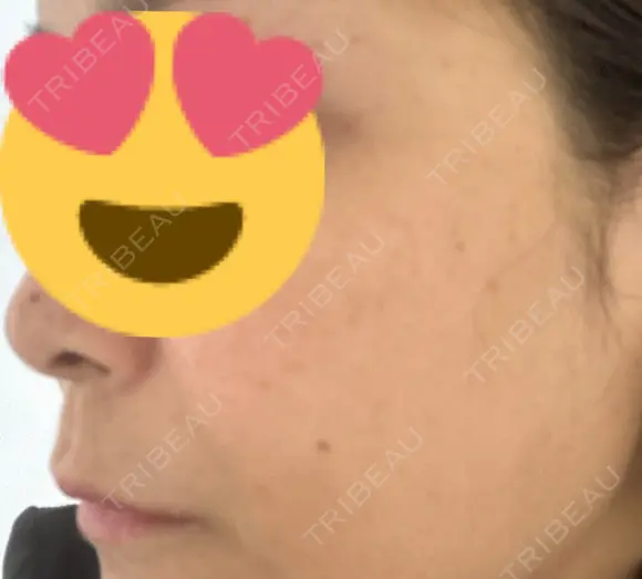 シミ取りレーザー Mavie Beauty Clinic （マヴィービューティークリニック） BEFORE メイン用