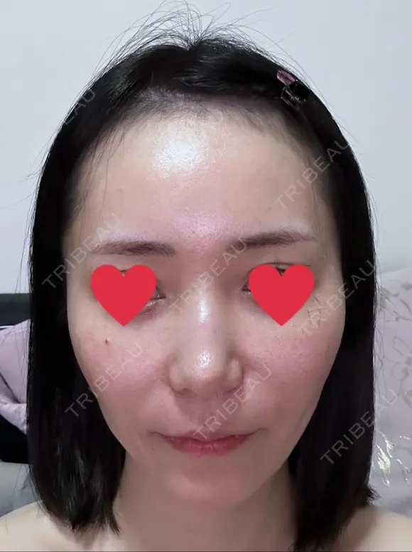 ハイフ（顔） 心斎橋形成外科スキンケアクリニック BEFORE メイン用