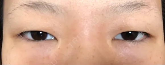眼瞼下垂（切開） 東京皮膚科・形成外科 (銀座いけだクリニック) BEFORE メイン用