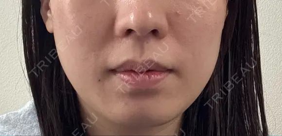 医療痩身（顔） リアルクリニック（REAL CLINIC） BEFORE メイン用