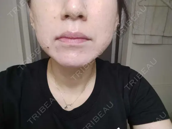 糸リフト / ヒアルロン酸注入（頬） ネビュラクリニック 広島院 BEFORE メイン用