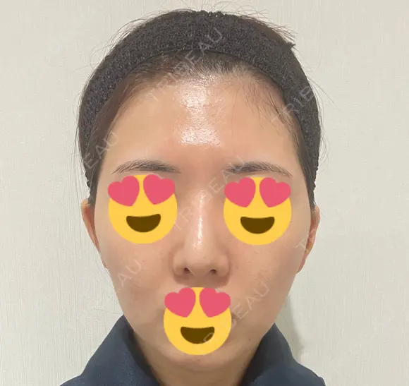 脂肪注入（額） GRACIA clinic 【グラシアクリニック】 BEFORE メイン用