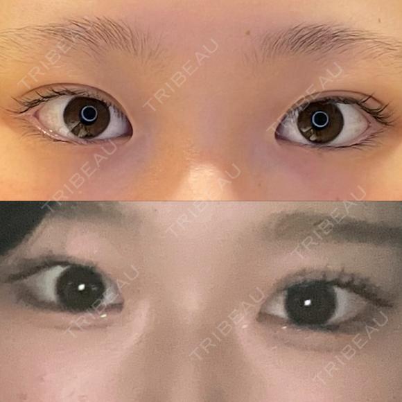目尻切開 / タレ目形成・グラマラスライン（埋没） / 美容点滴・美容注射（美肌） LOUIS CLINIC 二子玉川院【ルイクリニック】 BEFORE メイン用