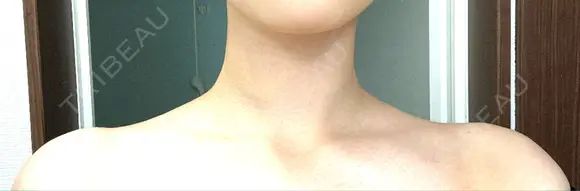 ボトックス（肩） TCB東京中央美容外科 新横浜院 BEFORE メイン用