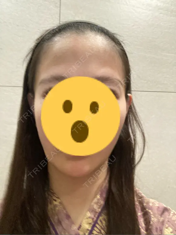 ハイフ（顔） リエンジャン整形外科 明洞店 BEFORE メイン用