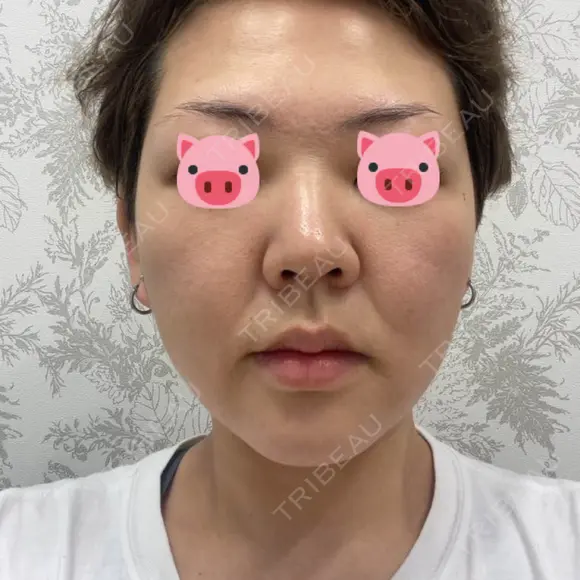 フラクショナルレーザー（毛穴・ニキビ跡） CLINICA BellaForma BEFORE メイン用