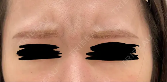 ボトックス（エラ・小顔） 美容皮膚科エルムクリニック 大阪院 BEFORE メイン用