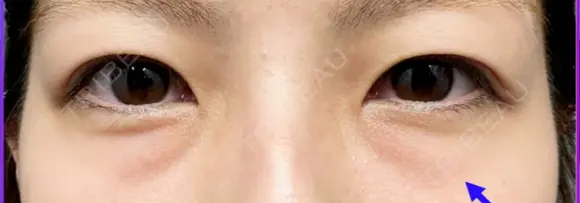 クマ治療 / 下まぶたたるみ取り / 下まぶたの脂肪取り 品川美容外科 渋谷院（※品川スキンクリニック提携） BEFORE メイン用