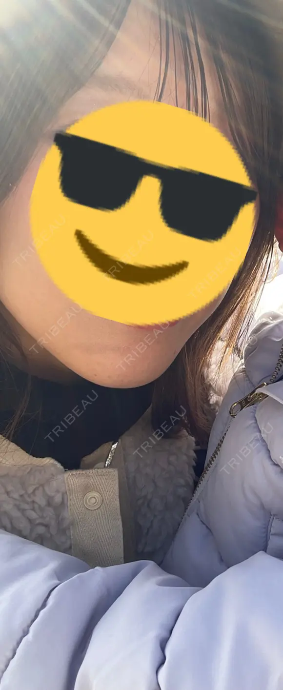 ハイフ（顔） / ハイフ（首） TCB東京中央美容外科 熊本院 BEFORE メイン用