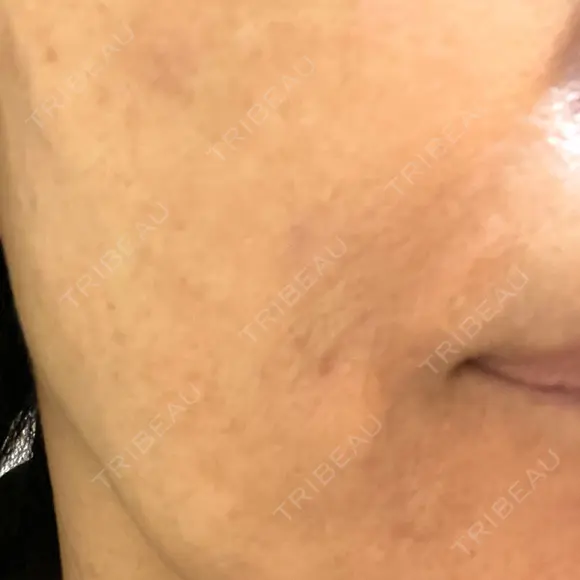 エレクトロポレーション / ピーリング（ハリ・ツヤ） LIFIX BEAUTY CLINIC BEFORE メイン用