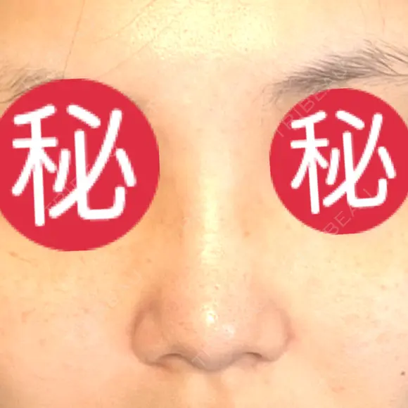 小鼻縮小（切開） / 軟骨移植 / 眉間プロテーゼ / 鼻尖形成（非切開） / 鼻柱下降・鼻唇角形成（猫手術） グローバルビューティークリニック 東京院 BEFORE メイン用