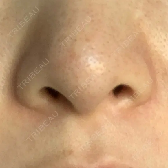 毛穴洗浄（ハイドラフェイシャルなど） 代官山ウィメンズクリニック BEFORE メイン用