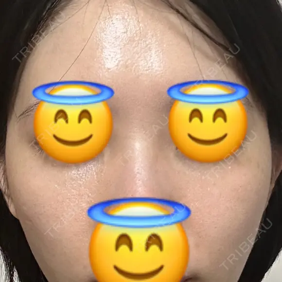 ヒアルロン酸注入（目の下） あじまビューティークリニック BEFORE メイン用