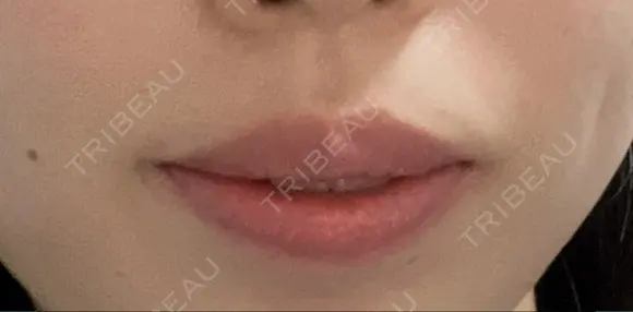 ヒアルロン酸注入（唇） 橿原 BEAUTY CLINIC BEFORE メイン用