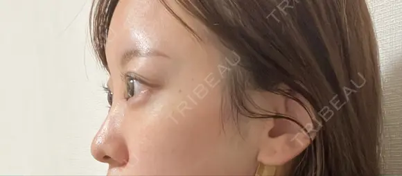 ヒアルロン酸注入（鼻翼基部） 東京シンデレラ美容外科 池袋院 BEFORE メイン用