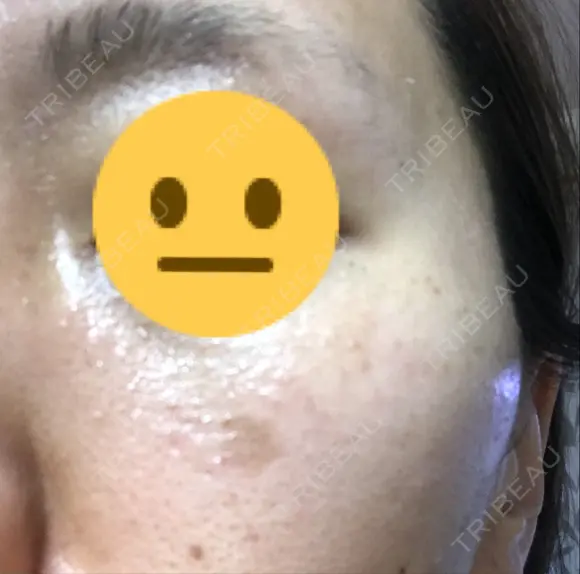 シミ取りレーザー 渋谷美容外科クリニック 横浜院 BEFORE メイン用