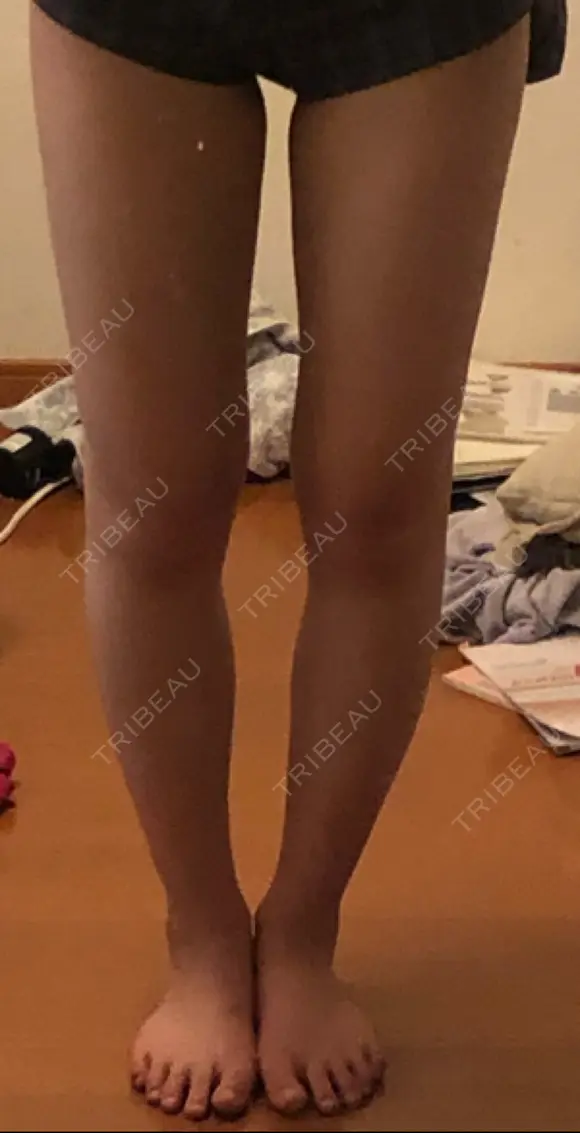 脂肪吸引（脚） ドクターフィット（Dr.fit）クリニック BEFORE メイン用