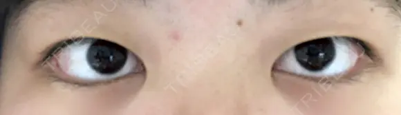 二重切開 / 目頭切開 / ほくろ・いぼ切除（肌） / 上まぶたたるみ取り / 上まぶたの脂肪取り 東京美容外科 銀座院 BEFORE メイン用