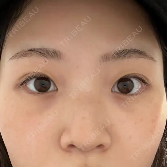 目頭切開 東京エビスクリニック BEFORE メイン用