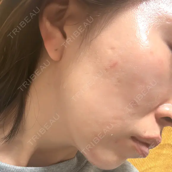 その他（肌） / ダーマペン ジョウクリニック 那覇院 BEFORE メイン用