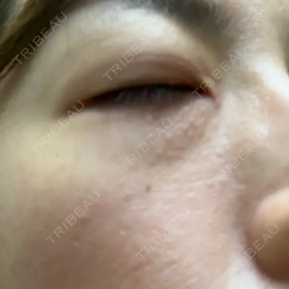 ニードルRF（ポテンツァなど） 表参道スキンクリニック 名古屋院（DAILY SKIN CLINIC提携院） BEFORE メイン用