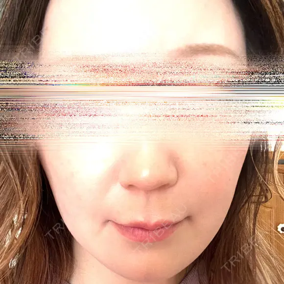 ハイフ（顔） 湘南美容クリニック 岐阜院 BEFORE メイン用