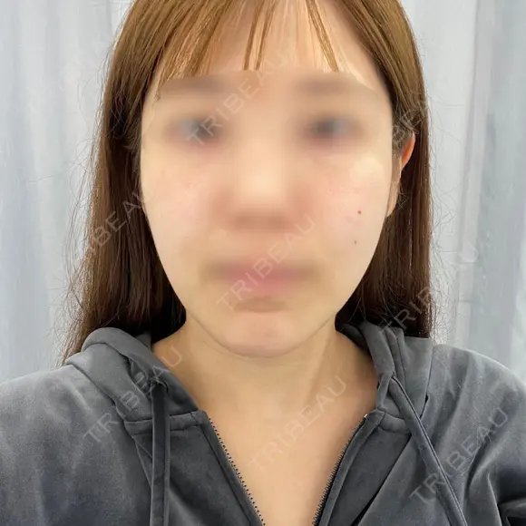 糸リフト / バッカルファット除去 / 脂肪吸引（顔） / 人中短縮 / 脂肪注入（額） / ジョールファット除去 / ヒアルロン酸注入（唇） BLINC CLINIC （ブリンク クリニック） BEFORE メイン用