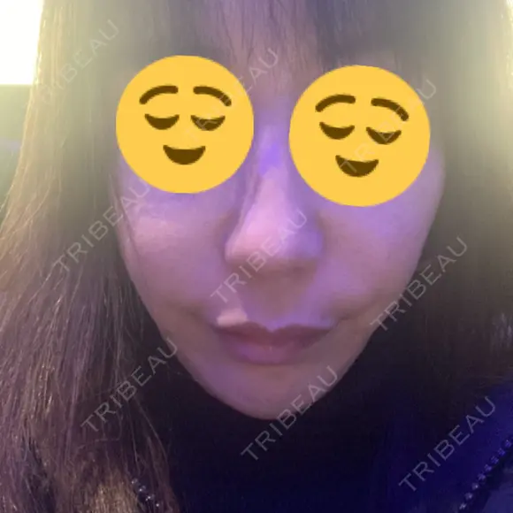 糸リフト / 脂肪吸引（顔） / ボトックス（エラ・小顔） / ヒアルロン酸注入（頬） Tokyo Tensei Clinic 新宿院 BEFORE メイン用