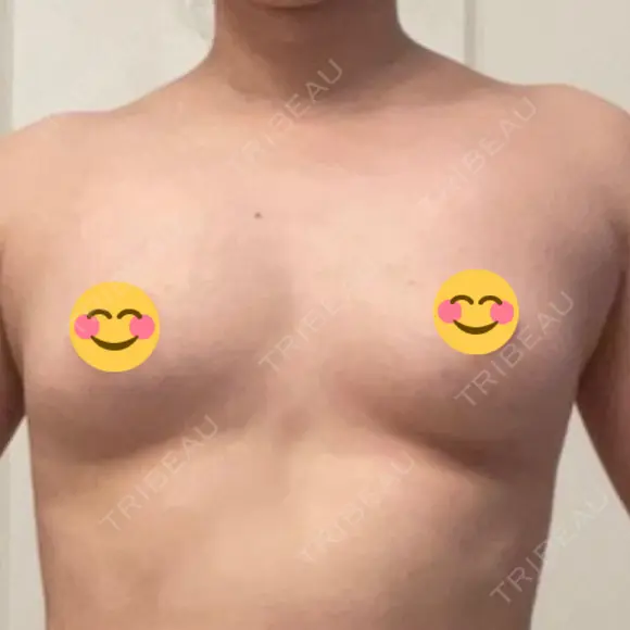 豊胸（脂肪注入） Mods Clinic（モッズクリニック） 東京院 BEFORE メイン用