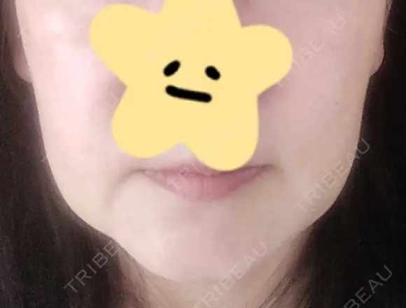 糸リフト 東郷美容形成外科　福岡 BEFORE メイン用