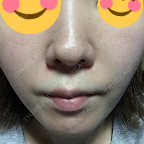 美肌レーザー みやた形成外科・皮ふクリニック BEFORE メイン用