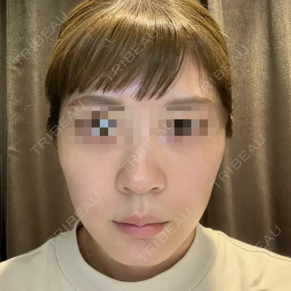 ヴェルヴェットスキン Olino美容外科・美容皮膚科 BEFORE メイン用