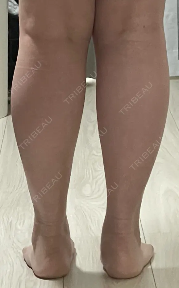 脂肪吸引（二の腕） / 脂肪吸引（脚） / ボトックス（ふくらはぎ） / ボトックス（二の腕） Mods Clinic（モッズクリニック） 福岡院 BEFORE メイン用