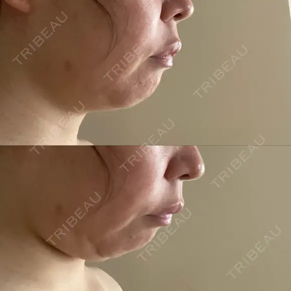糸リフト / 脂肪吸引（顔） 自由が丘ウェルエイジングビューティークリニック BEFORE メイン用