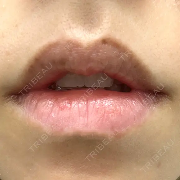 シミ取りレーザー Jスキンクリニック 【J-SKIN clinic】 BEFORE メイン用
