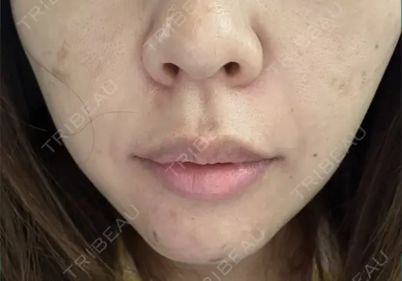 糸リフト 共立美容外科 梅田院 BEFORE メイン用