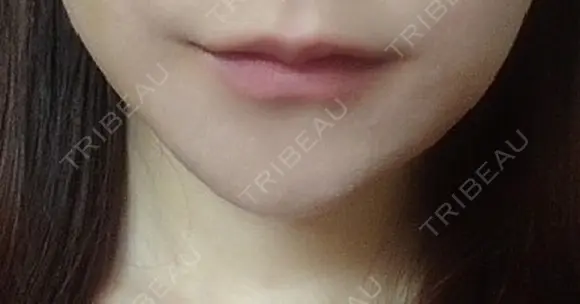 ヒアルロン酸注入（唇） ライアン美容外科 BEFORE メイン用