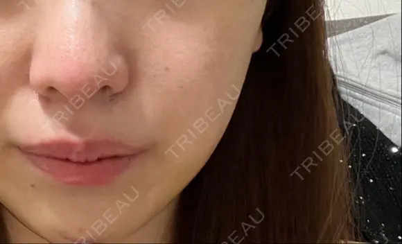 毛穴洗浄（ハイドラフェイシャルなど） 東京素肌クリニック 銀座本院 BEFORE メイン用