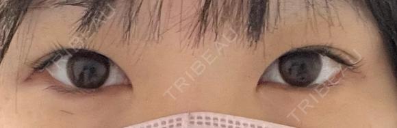 二重埋没 東京形成美容外科 銀座院 BEFORE メイン用