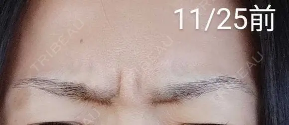 ボトックス（眉間） / その他（肌） 湘南美容クリニック 宇都宮院 BEFORE メイン用