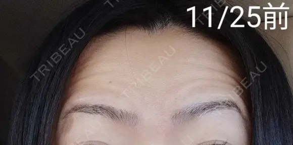 ボトックス（額） 湘南美容クリニック 宇都宮院 BEFORE メイン用