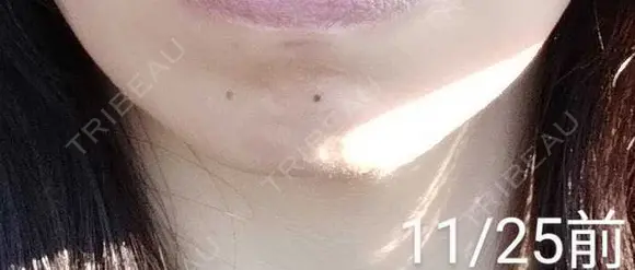 ボトックス（あご） 湘南美容クリニック 宇都宮院 BEFORE メイン用