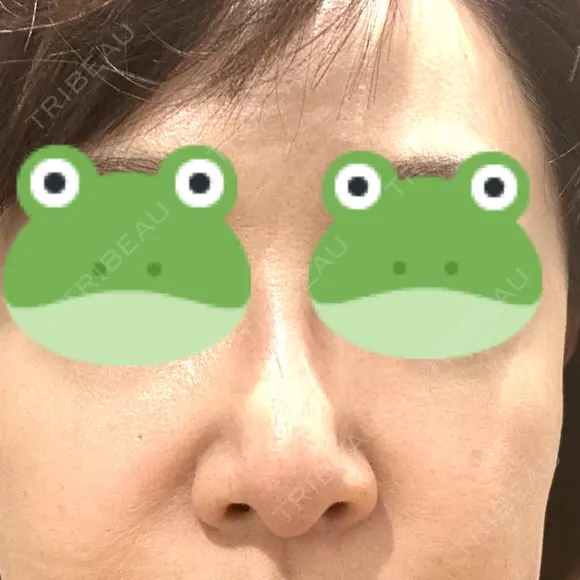 ボトックス（眉間） / ボトックス（首） AILE Clinic BEFORE メイン用
