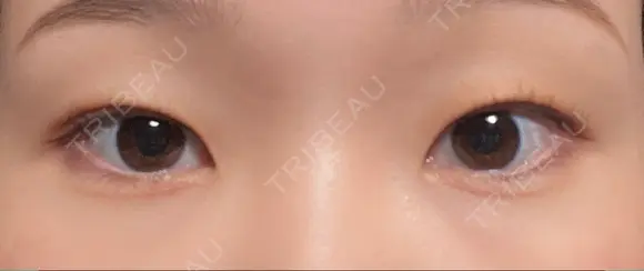 二重埋没 水の森美容クリニック 東京銀座院 BEFORE メイン用